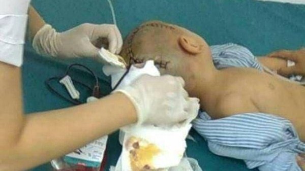 Bé 3 tuổi bị chấn thương sọ não tại trường mầm non