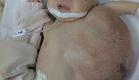 Hy hữu: Bé 20 ngày tuổi có khối u to bằng cơ thể