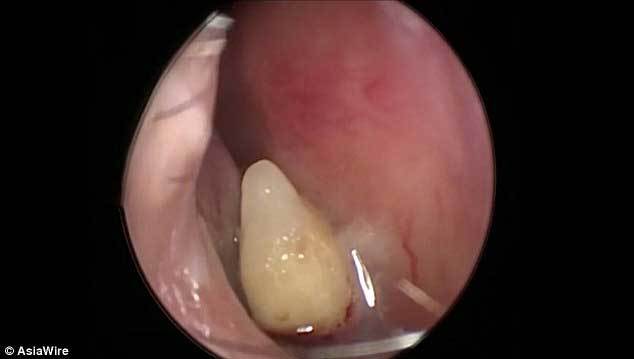 Tưởng viêm mũi, đi khám phát hiện chiếc răng lạ