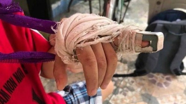 Phụ huynh phản ánh cô giáo đánh trẻ 5 tuổi gãy ngón tay