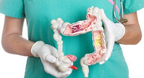 Từ viêm đại tràng tới ung thư đại trực tràng rất gần