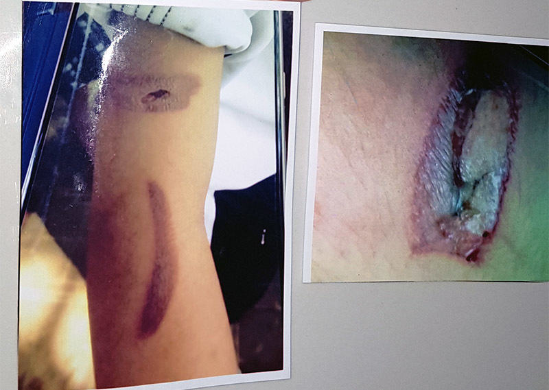 Công an làm rõ vụ bé gái nghi bị cha ruột và mẹ kế bạo hành