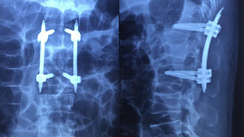 Bắt vít qua da cứu bệnh nhân chấn thương cột sống