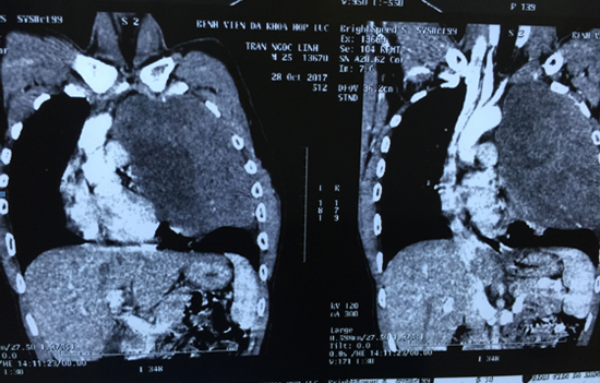 Nam thanh niên khó thở, bóc ra khối u như quả bóng