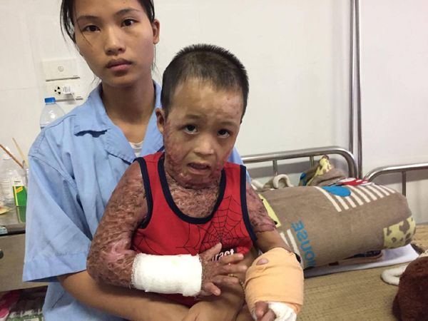 Bé trai bị cụt chân, biến dạng do bỏng nặng cần giúp đỡ