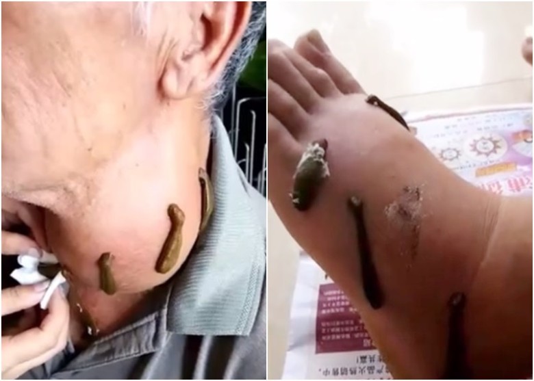 Thực hư dùng đỉa chữa 'bách bệnh' ở Trung Quốc