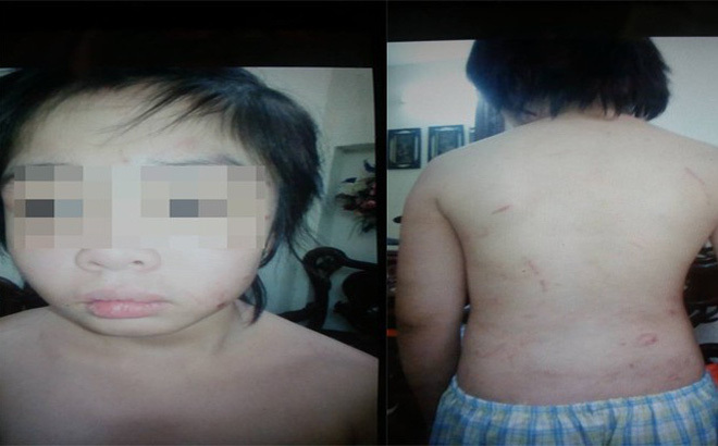 Hà Nội: Bé trai tố bố và mẹ kế đánh thương tích đầy người