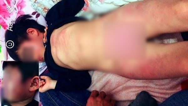 Bé 4 tuổi bầm tím ở lớp: Bị bạn đánh, không phải cô giáo
