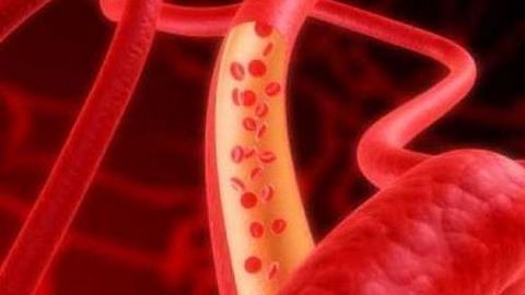Máu nhiễm mỡ dễ gây biến chứng gì?