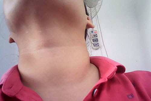 Bệnh bướu cổ nên ăn gì, kiêng gì?