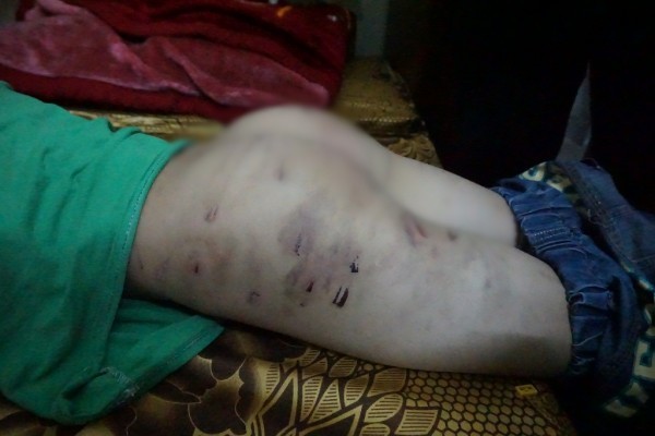 'Tôi chỉ đánh con vài vết lằn mông, còn lại cháu bị nhọt'