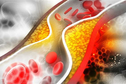 5 nguyên nhân chính dẫn đến hiện tượng mỡ máu cao
