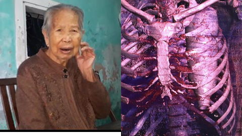 Hy hữu nhất 2017: Bật dậy khi đang lo ma, chai chui tọt lồng ngực