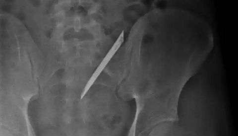 Lấy lưỡi dao 12 cm nằm 4 năm ở lưng nam thanh niên