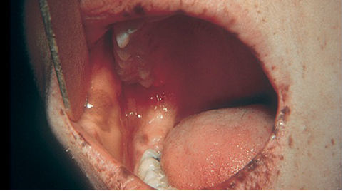 Nốt sắc tố sậm màu trong miệng báo hiệu điều gì?