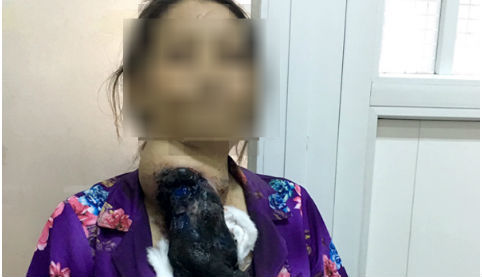 Bướu to như trái xoài lở loét do đắp thuốc lá của thầy lang