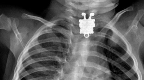 Bé trai nuốt bóng đèn suốt 1 năm mới được phát hiện