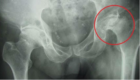 Hoại tử khớp háng khi tiêm corticoid chữa ngứa đầu