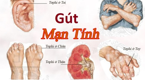 ‘Chế ngự’ gút mạn tính bằng Hoàng Tiên Đan