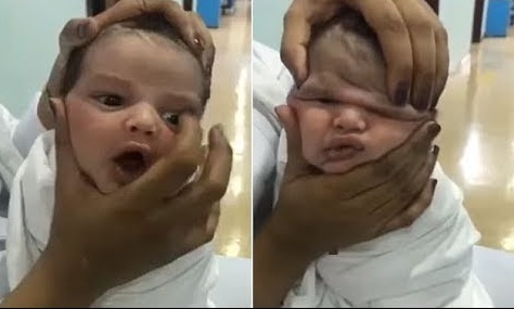 Y tá bị sa thải vì vò mặt bé sơ sinh