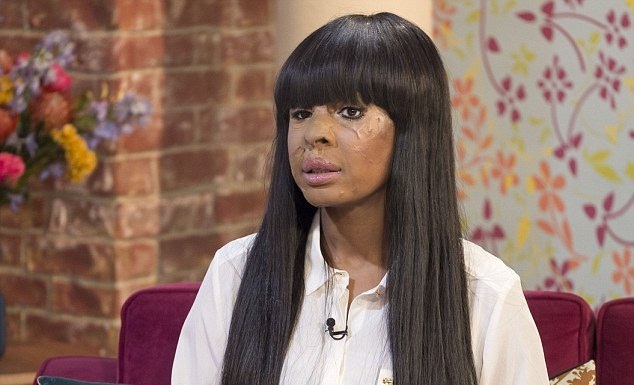 Nỗi đau tột cùng của thiếu nữ bị tạt axit vì quá đẹp