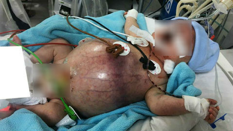 Kỳ tích cứu sống bé sơ sinh thủng ruột từ trong bụng mẹ