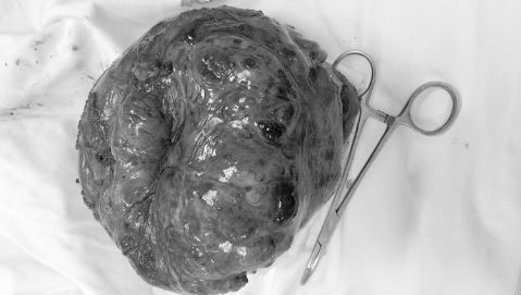 Sụt cân, nôn ra máu lấy ra u dạ dày 2 kg