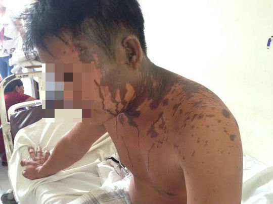 Vợ tạt a xít chồng vì ghen