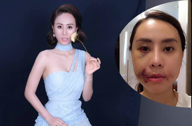 Á hậu Thuỳ Linh công khai khuôn mặt sưng phồng vì thẩm mỹ