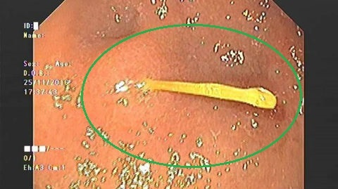 Hy hữu chiếc tăm tre chui vào ổ bụng, đâm thủng ruột