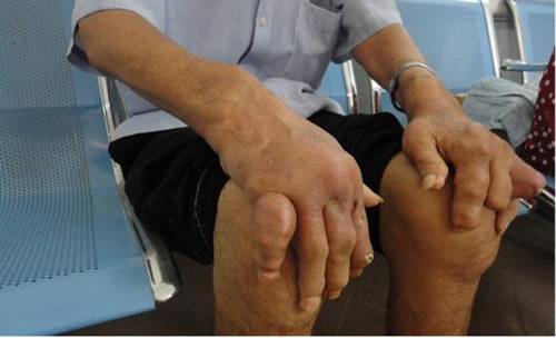 Hiểu bệnh gout từ A đến Z