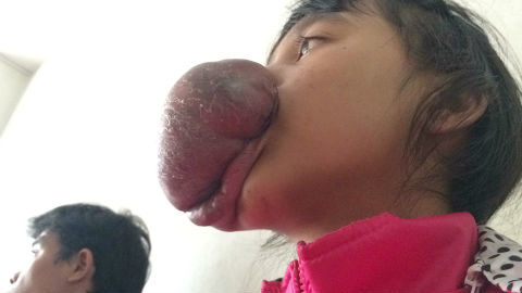 Phẫu thuật 'giải thoát' khối u máu khổng lồ ở miệng thiếu nữ