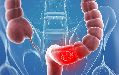 Hỗ trợ điều trị viêm đại tràng nhờ công nghệ Nhật