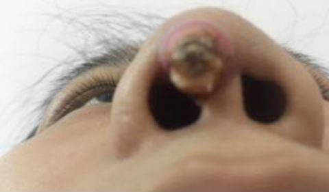 Nâng mũi giá rẻ ở spa, cô gái bị silicon đâm lòi sống mũi