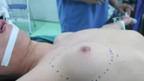 Nam thanh niên ngại ngùng vì ngực to như phụ nữ