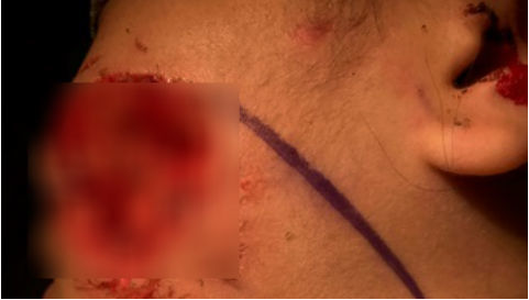 Bé gái bị chó cắn mất mảng thịt ở mặt