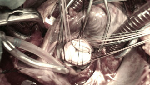 Suýt tử vong vì ổ vi trùng trú ngụ trong răng